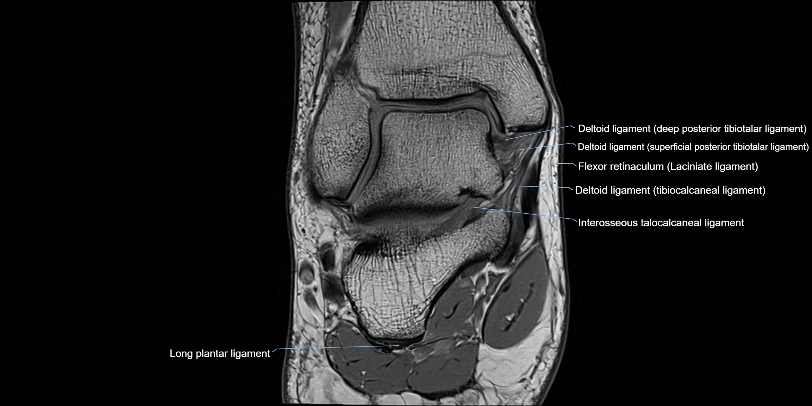 MRI Ankle coronal ligaments cross sectional anatomy 3T  radiology  image-img-00001-00012.webp